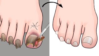 ASMR Ingrown Toenail Removal Treatment Animation  ENJO Relaxing [upl. by Otrebmal244]