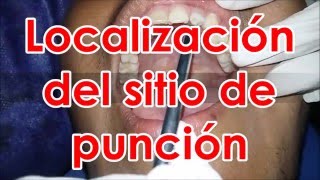 Tecnicas de anestesia en odontologia [upl. by Daisey273]