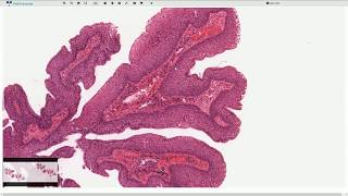 Squamous Papilloma  Larynx  Histopathology [upl. by Valeda538]