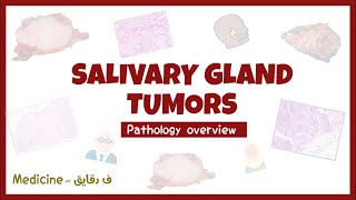 Salivary glands tumors  Pleomorphic adenoma Warthin tumor pathology overview شرح [upl. by Orihakat]