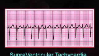 Introduction to EKG Rhythm Interpretation Part 3 [upl. by Emirac]