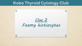 Diagnostic clues and pitfalls of thyroid FNA Clue 2 Foamy histiocytes [upl. by Anayia]