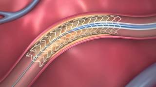 FDAApproved Dissolving Heart Stent  How It Works [upl. by Munn]