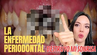 Perdí un diente por enfermedad periodontal 😱  ¿Como evitarlo [upl. by Drofiar692]