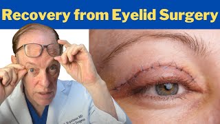 How to Recover from a Blepharoplasty  Plastic Surgeons Guidance on Eyelid Surgery Recovery [upl. by Eelyrehc666]