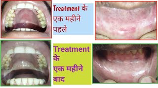 OSMF Early to Advance Stage Problem amppatient treatment resultOral Submucous Fibrosis and ulceration [upl. by Lilli]