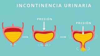 URÓLOGO Incontinencia Urinaria Qué es causas tipos de INCONTINENCIA y tratamiento [upl. by Nelyak]