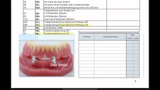 CoverdentureProthesen oder Deckprothesen  HKP abrechnen 44 [upl. by Seko]