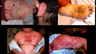 Stelara Side Effects  Stelara causes drug induced psoriasis  Biologic problems [upl. by Jazmin]