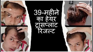 39 month hair transplant result Hindi  KV life in USA [upl. by Perseus]