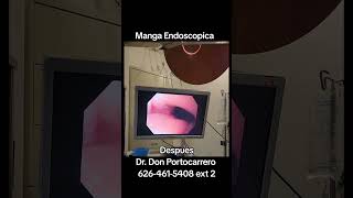 Manga Endoscopica Producto Final con el Dr Don Portocarrero en Los Angeles CA [upl. by Drake694]