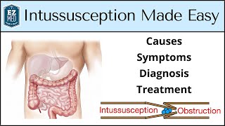 Intussusception Causes Symptoms Diagnosis Treatment Nursing USMLE [upl. by Ettedo]