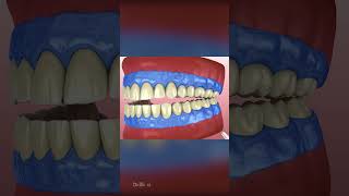 Teeth Whitening Process [upl. by Bremen]