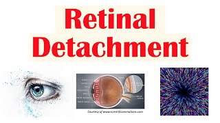 Retinal Detachment  Types Risk Factors Pathophysiology Signs amp Symptoms Diagnosis Treatment [upl. by Aroda]