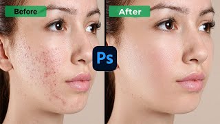 Advance High Level Skin Retouching In Photoshop  Remove Acne and Pimples [upl. by Bohman833]