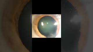 IRIS COLOBOMAOPHTHALMOLOGYEMBRYOLOGY [upl. by Ayikat]