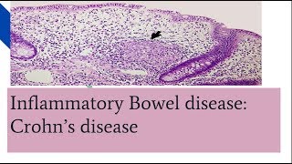 Crohns disease PathogenesisMorphology and clinical features [upl. by Katee]