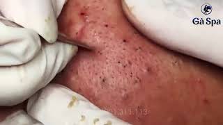 Blackheads 7750 [upl. by Nosyt]