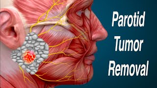 Parotid Mass Removal and Facial Nerve Considerations Parotidectomy [upl. by Amsden518]