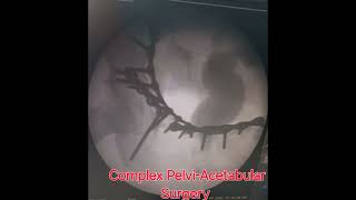 Complex PelviAcetabular Surgery  Dr Nikhil Verma complextrauma complexhipfracture acetabulum [upl. by Sylvie948]