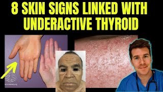 Doctor explains 8 SKIN SIGNS linked with HYPOTHYROIDISM aka underactive thyroid [upl. by Leia]