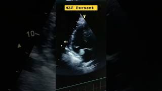 Global LV hypokinesia Severe LV Dysfunction Moderate Aortic stenosis MAC hferf heartfailure [upl. by Orozco]