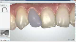 Dental System 2013  TRIOS Color Digital Temporary  3Shape [upl. by Alie]