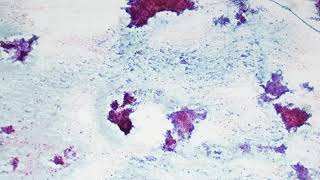 Pleomorphic adenoma Cytology [upl. by Sukramaj]