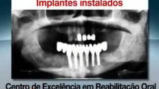 Implantes dentários com carga imediata [upl. by Eelrak]