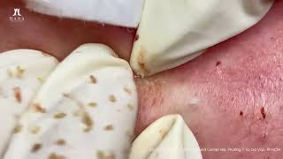 Big Cystic Acne Blackheads Extraction Blackheads amp Milia Whiteheads Removal Pimple Popping [upl. by Linder208]