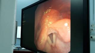 Bronchoscopy Video  How to Perform Bronchoscopy [upl. by Nwahsuq]