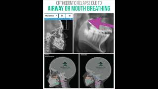 Orthodontic Relapse Due to Airway Issues and Mouth breathing [upl. by Adnik]