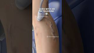 Super glue for your veins 3D Animation [upl. by Strenta755]