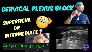 SUPERFICIAL CERVICAL PLEXUS BLOCK 🔴🔴 ULTRASOUNDGUIDED 🔴🔴 LANDMARK amp LOR 🔴🔴 TIPS amp TRICKS [upl. by Berners]