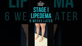 LIPOSUCTION FOR LIPEDEMA  STAGE 1 LEGS AND KNEES lipedema [upl. by Euh]