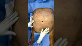 Lipoescultura con Lipotransferencia en paciente MASCULINO de 93 kg 💪🔥 cirugiaplastica lipo [upl. by Dinsdale594]