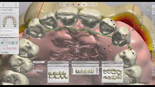 3shape full denture design [upl. by Minton227]