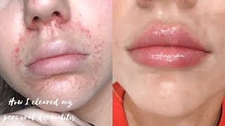 HOW I CLEARED MY PERIORAL DERMATITIS [upl. by Ariay]