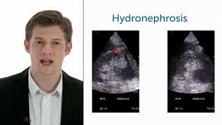 How To Evaluate Hydronephrosis In Point of Care Ultrasound [upl. by Layla910]