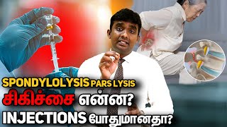 L45 L5S1 Spondylolisthesis Part 8 சிறு வயதில் பாதிப்பு ஏற்படுமா [upl. by Nnylav]