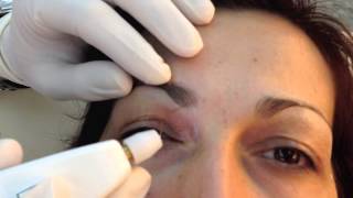 Not Surgical aesthetic blepharoplasty with PLEXR [upl. by Annairba]