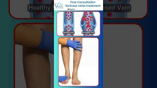 varicose veins treatment varicoseveins telugu hospital symptom veinsctomyvaricose veins shorts [upl. by Rhys]