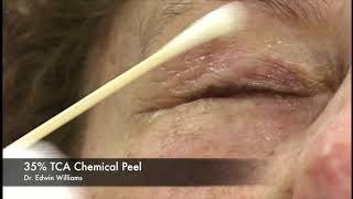 35 TCA Chemical Peel by Dr Edwin Williams for Wrinkles amp Sun Damage [upl. by Zetrom]