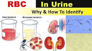 RBC In Urine  Why amp How to Identify [upl. by Azenav]