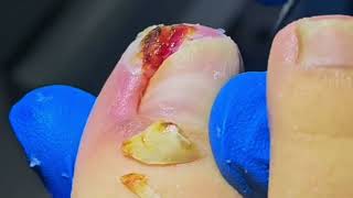 Remove a ROTTEN Toenail to Find a HUGE Ingrown Nail [upl. by Bopp]