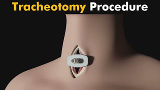 How Tracheotomy is performed  Tracheotomy 3D Animation UrduHindi [upl. by Ahsyek]