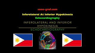 Echocardiography  Inferolateral At Inferior Hypokinesia [upl. by Lyssa]