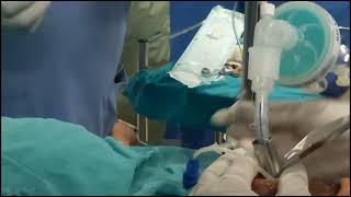 Endotracheal intubation with intubating LMA [upl. by Ahsap155]