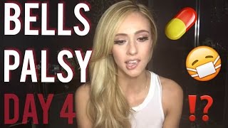 Bells Palsy Recovery and Home Remedies Ive been trying  Day 4 [upl. by Novanod]