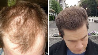 How To Distinguish Between Androgenetic Alopecia And Telogen Effluvium [upl. by Nawaj249]